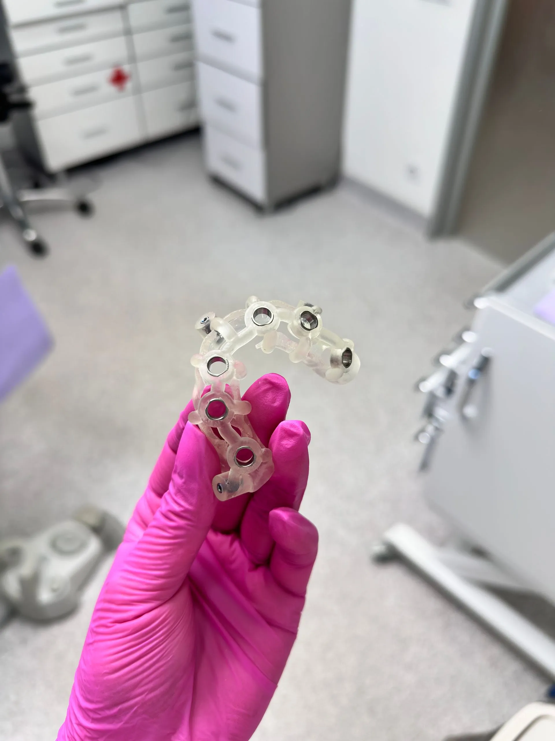 Guía quirúrgica dental impresa en 3D para cirugía de implantes guiada por ordenador